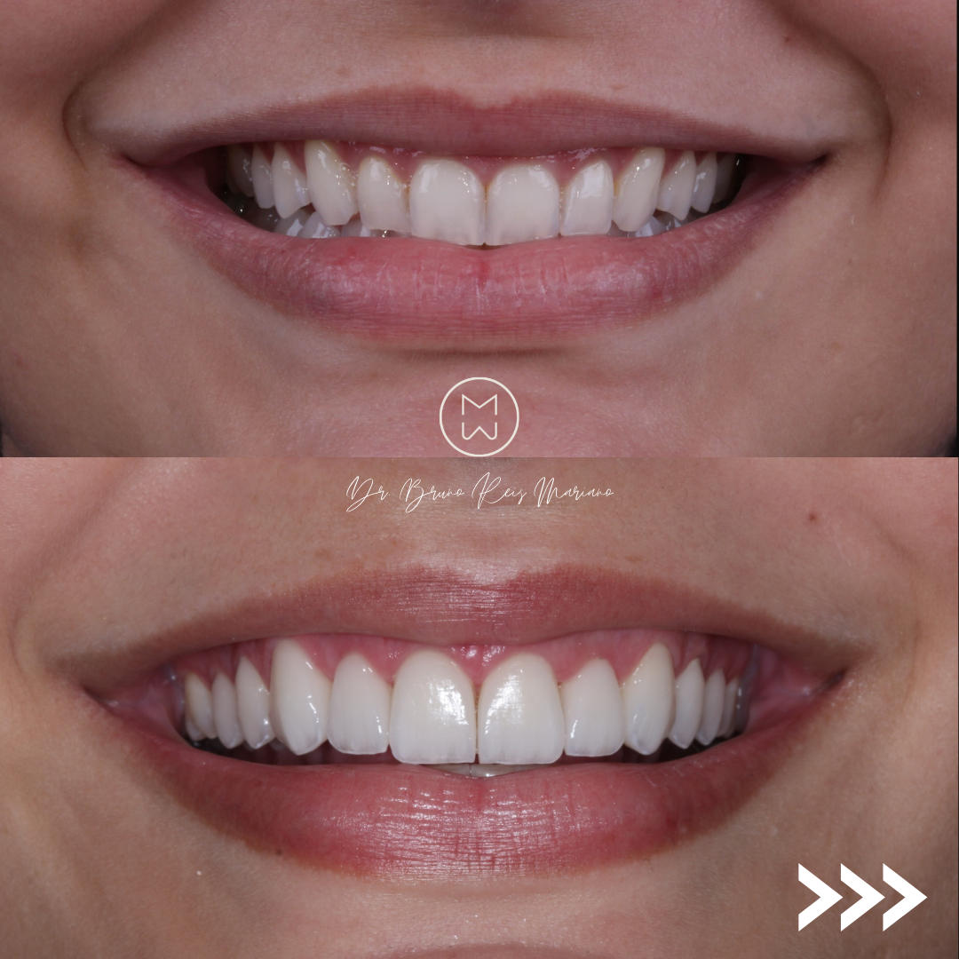 Antes e depois implantes dentarios